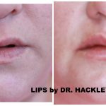 Dermal Fillers Rockville