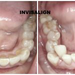 invisalign maryland