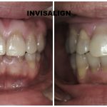 invisalign rockville