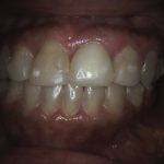 before photo teeth maryland