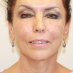fillers rockville