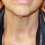 dermal filler maryland