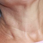 neck filler rockville