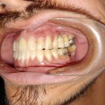before teeth cleaning rockville