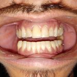 before teeth cleaning maryland