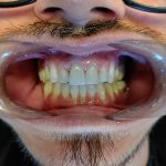 after teeth cleaning maryland