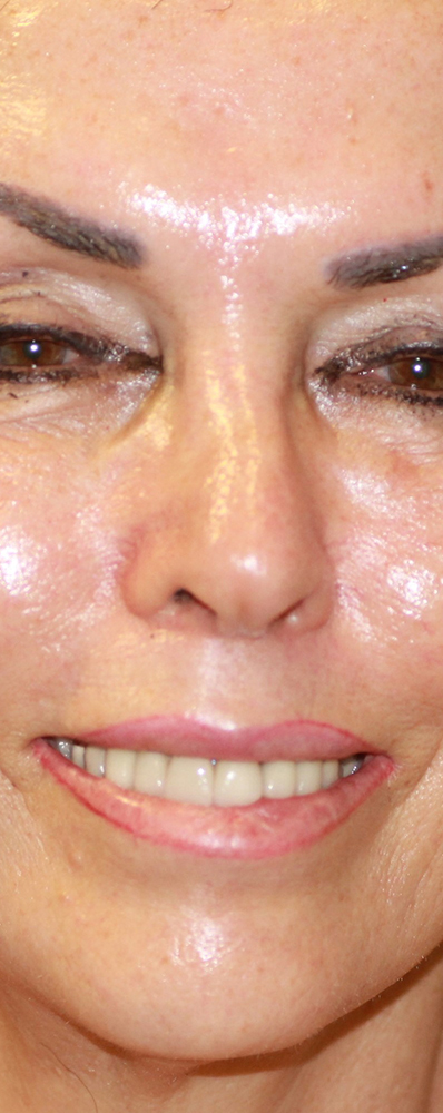 lip fillers rockville