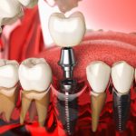 dental implants maryland