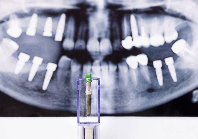 dental implant dentist near me
