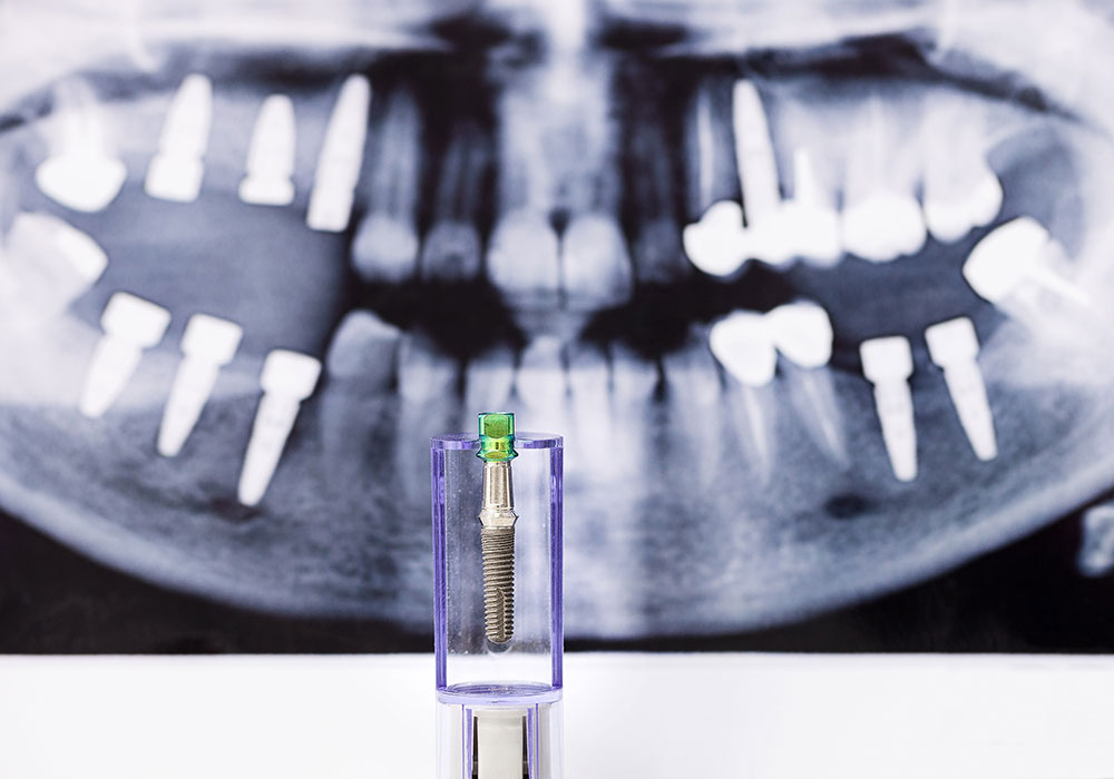 dental implant dentist near me