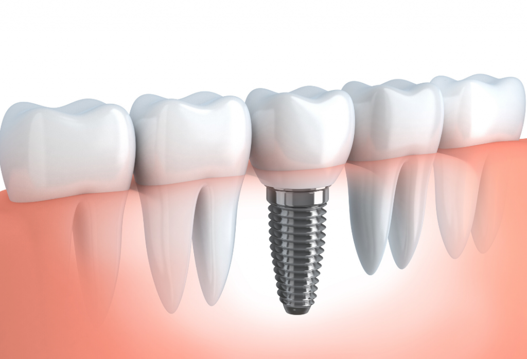 dental implants maryland