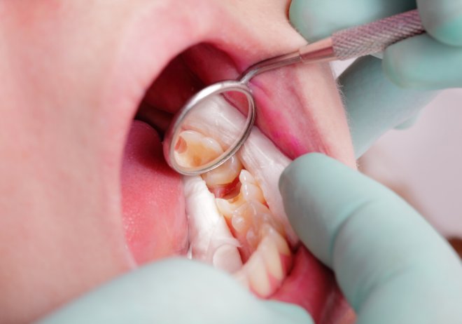 cost of dental crowns