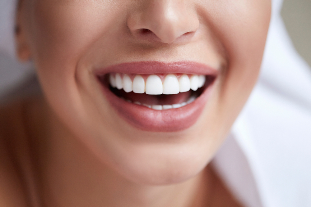 How Much Are Veneers?