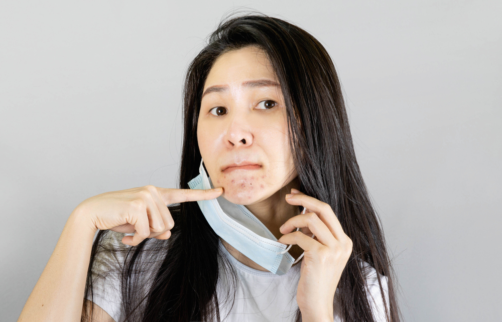 HydraFacial Acne Treatment