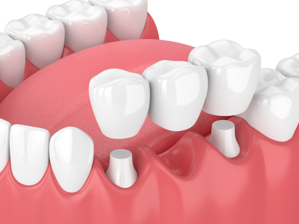 Dental Bridge Specialist in Rockville