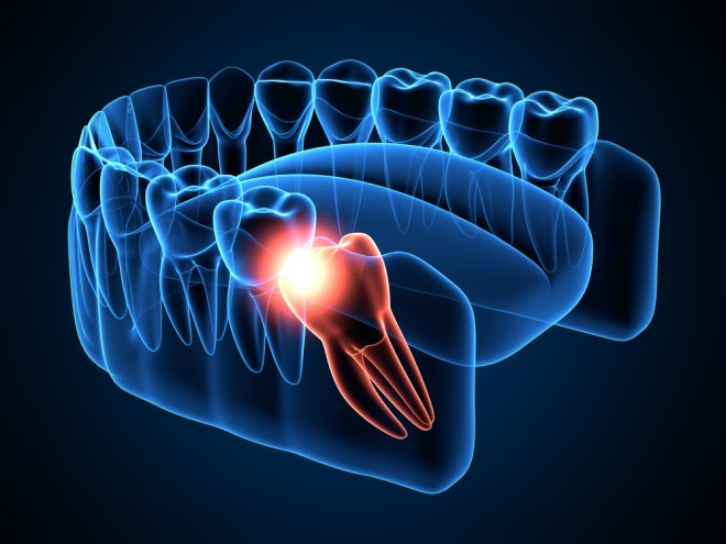 Wisdom Teeth