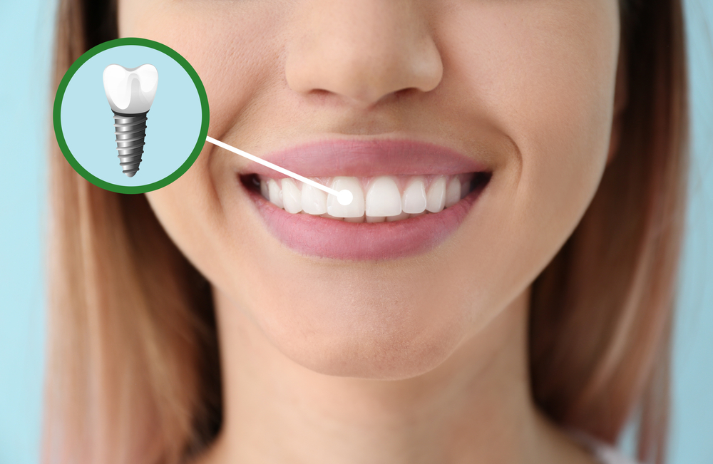 Will My Insurance Cover Dental Implants?