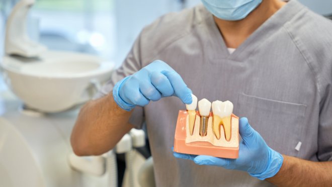 Rockville Dental Implants