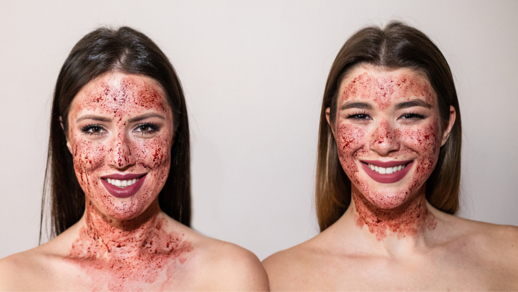 Microneedling with PRP in Maryland