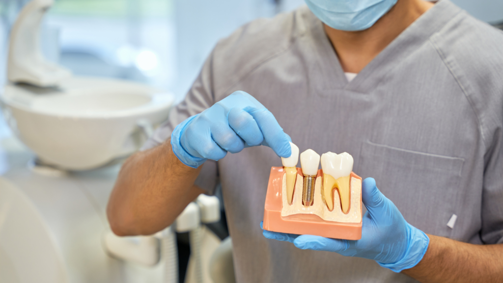 Rockville Dental Implants